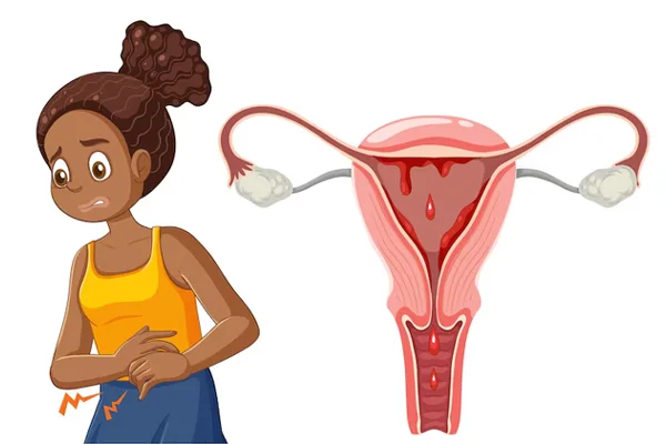 Abnormal Uterine Bleeding