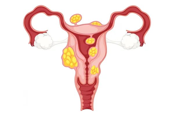 Fibroids